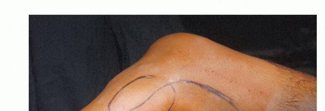 Illustration 7 for Beyond Amputation: The Type I Resection in Fibular Tumor Surgery