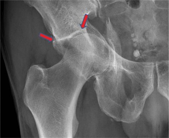 Geriatric Case: Optimal Treatment for Acetabular Fractures