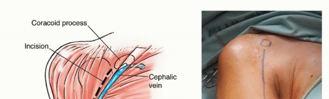 Illustration 6 for Restore Vital Function: Surgery for Type II Humeral Metastasis