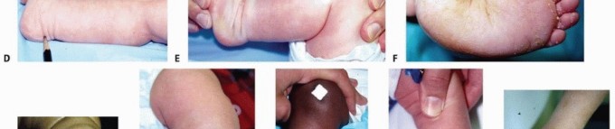 Illustration 3 for Resistant Clubfoot Solved: Posteromedial and Posterolateral Release