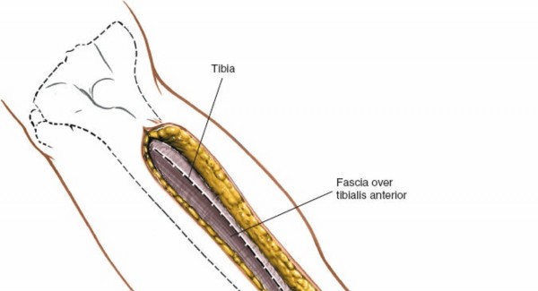 Illustration 61 for Surgical Access: Mastering the Tibia's Surface & Fibula Approaches