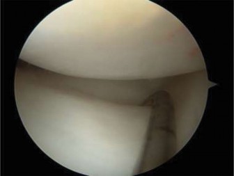 Illustration 10 for Pediatric OCD: When to Consider Drilling for the Femoral