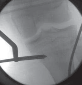 Illustration 13 for Pediatric Tibial Fractures: Avoid Mistakes, Ensure Optimal Healing