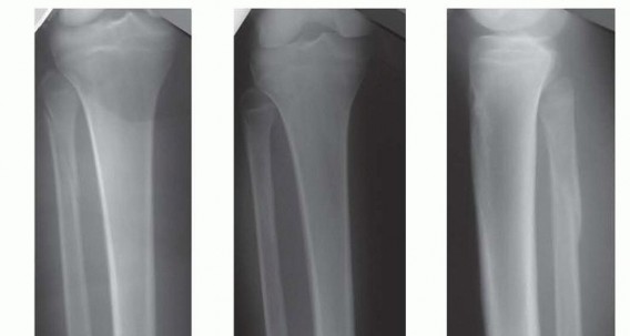 Illustration 4 for Optimizing Intramedullary Nailing for Tibial Shaft Fractures