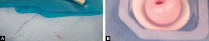 Illustration 29 for Approaches Posterolateral Surgical: A Guide to Enhanced Hip Surgery