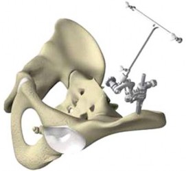Illustration 20 for Minimizing Risks: Computer Navigation in Hip Resurfacing Arthroplasty