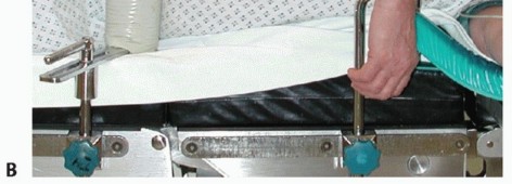 Illustration 8 for Distal Humeral Fractures: When Is Elbow Replacement the Best Option?