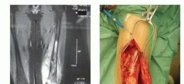 Illustration 6 for Expandable Prostheses: Understanding Infection Risk for Young Patients
