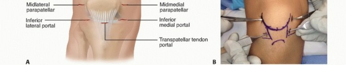 Illustration 12 for Treating Tibial Spine Fractures: Arthroscopy or Open Reduction?