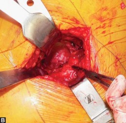 Illustration 24 for Exploring the Ambulatory Surgical Setting for Total Hip Replacement