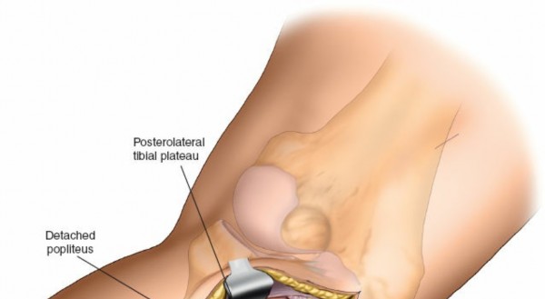 Figure 19: Clinical image of a wound infection post-tibial plateau fracture fixation.
