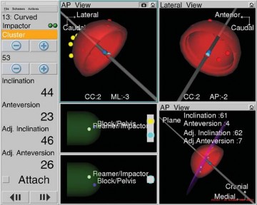 Illustration 24 for Avoiding Errors: Navigation in Total Hip Arthroplasty