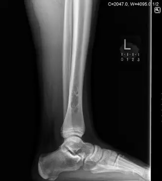 صورة توضيحية لـ آلام العظام بعد علاج السرطان: هل هي ورم ليفي حميد أم نقائل خبيثة؟ دليل الأستاذ الدكتور محمد هطيف للتشخيص والعلاج الدقيق