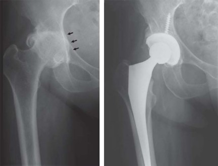 Illustration 11 for Maximize Success: Preoperative planning in primary Hip Replacement