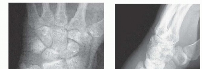 Illustration 11 for Arthroscopic Fixation: Effectively Treating Radial Styloid Fragments