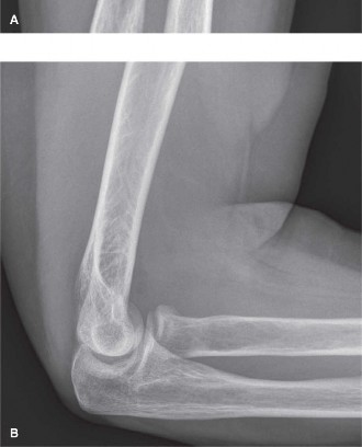 Illustration 2 for Radial Head Fracture: Symptoms, Diagnosis, and Surgical Indications