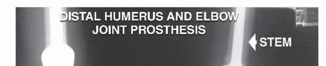 استئصال الجزء البعيد من عظم العضد: تقنيات آمنة للحفاظ على الطرف في صنعاء مع الأستاذ الدكتور محمد هطيف