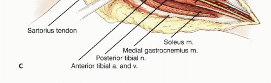 Illustration 22 for Tackling Complex Tumors of the Proximal Tibia: Limb-Sparing Solutions