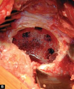 Illustration 16 for Optimizing Acetabular Component Cementation for Superior Outcomes