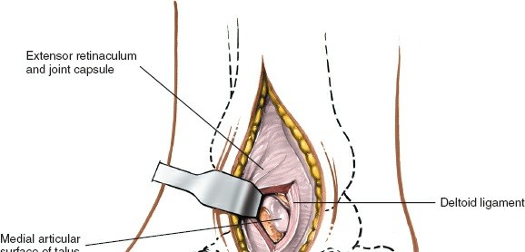 Illustration 20 for Optimized Approaches to the Dorsum of the Foot & Ankle