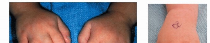 Illustration of syndactyly release of simple - Dr. Mohammed Hutaif