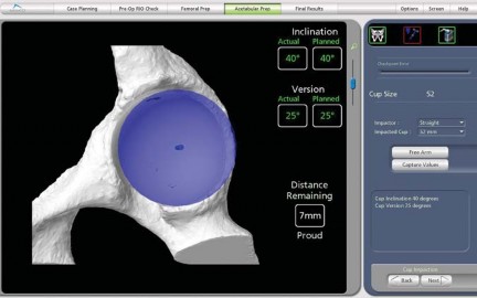 Illustration 38 for Robotics in Total Hip Arthroplasty: A New Era of Precision