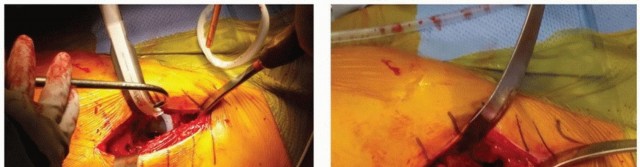 Illustration 4 for The Tapered Stem: Your Guide to Durable Cementless Hip Fixation