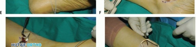 Illustration 28 for Restore Movement: Tendon Transfer for Common Peroneal Nerve Foot Drop