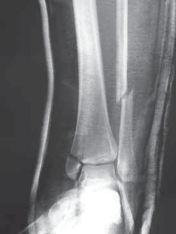 Illustration 11 for Optimal Fixation of the Ankle: Open Reduction & Internal Fixation