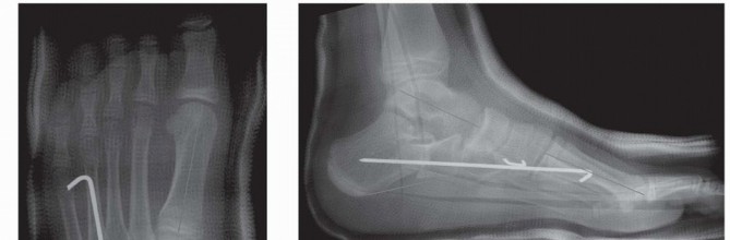 Illustration 22 for Calcaneal Lengthening Osteotomy: Correcting Hindfoot Valgus