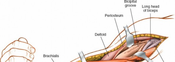 Illustration 14 for Mastering the Approach to the Distal Humerus: Safety & Skills