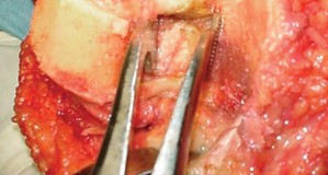 Illustration 13 for Precision Soft Tissue Balancing in Revision: Avoid TKA Pitfalls