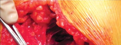 Illustration 14 for Unlock better THA: The technique of short stem for less invasiveness