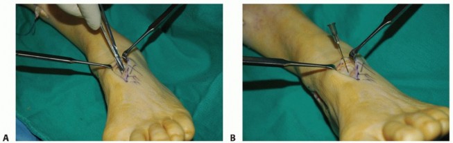 Illustration 31 for Restore Movement: Tendon Transfer for Common Peroneal Nerve Foot Drop