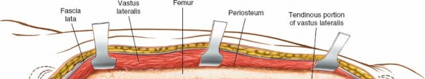 Illustration 11 for Optimal Femoral Approaches: Mastering the Lateral Intermuscular Septum