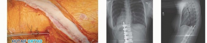 Illustration 43 for Anterior Interbody Arthrodesis for Scoliosis: What You Need to Know