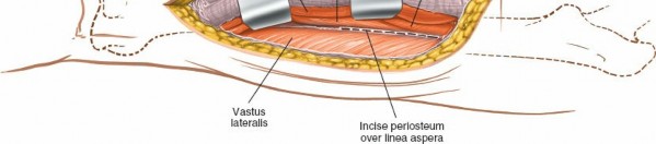 Illustration 41 for Optimal Femoral Approaches: Mastering the Lateral Intermuscular Septum