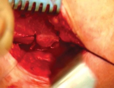 Illustration 20 for Mastering the Anterolateral Approach in Minimally Invasive Hip Replacement