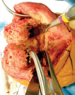 Illustration 29 for Precision Soft Tissue Balancing in Revision: Avoid TKA Pitfalls