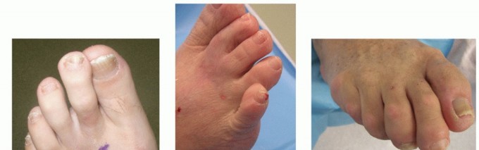 Toe Deformity Pain? Rebalance Flexor to Extensor for Relief