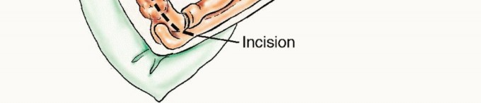 Illustration 36 for Restore Vital Function: Surgery for Type II Humeral Metastasis
