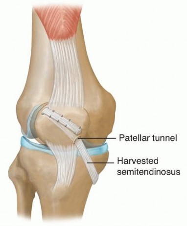 Illustration 20 for Chronic Patellar Instability: From Acute Onset to Lasting Solutions