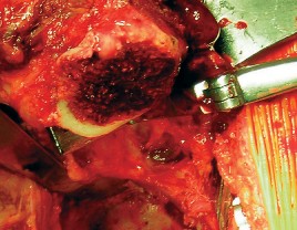 Illustration 46 for Cemented Component Longevity: The Critical Margin of the Acetabulum