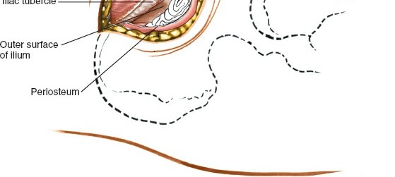 Illustration 9 for Pelvis & Acetabulum Approaches: Unlocking the Posterior Superior Iliac