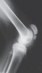 Illustration 2 for Unlocking Mobility: Distal Lengthening for Lateral Hamstring Muscle