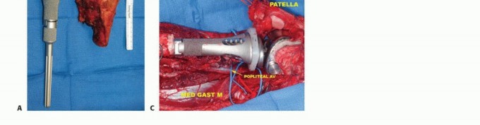 Illustration 20 for Distal Femoral Replacement: Key to Modern Limb Salvage