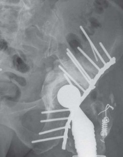 Illustration 14 for Management of Periprosthetic Fractures: An Expert Surgical Guide