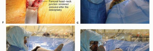 Illustration 24 for Anterior FAI Relief: Mini-Open Anterior Approach Explained