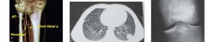 Illustration 19 for Understanding Benign Bone Tumors: Your Complete Preoperative Guide