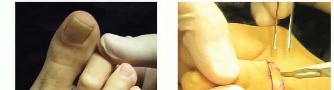 Illustration 13 for Plantar Plate Repair: End Lesser Toe Pain & Instability